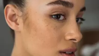 لکه قهوه ای روی پوست و ملاسما