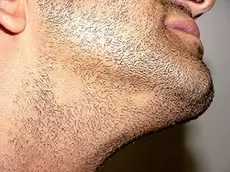 ریزش ریش چگونه اتفاق می افتد؟